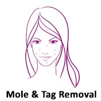 Mole & Tag Removal